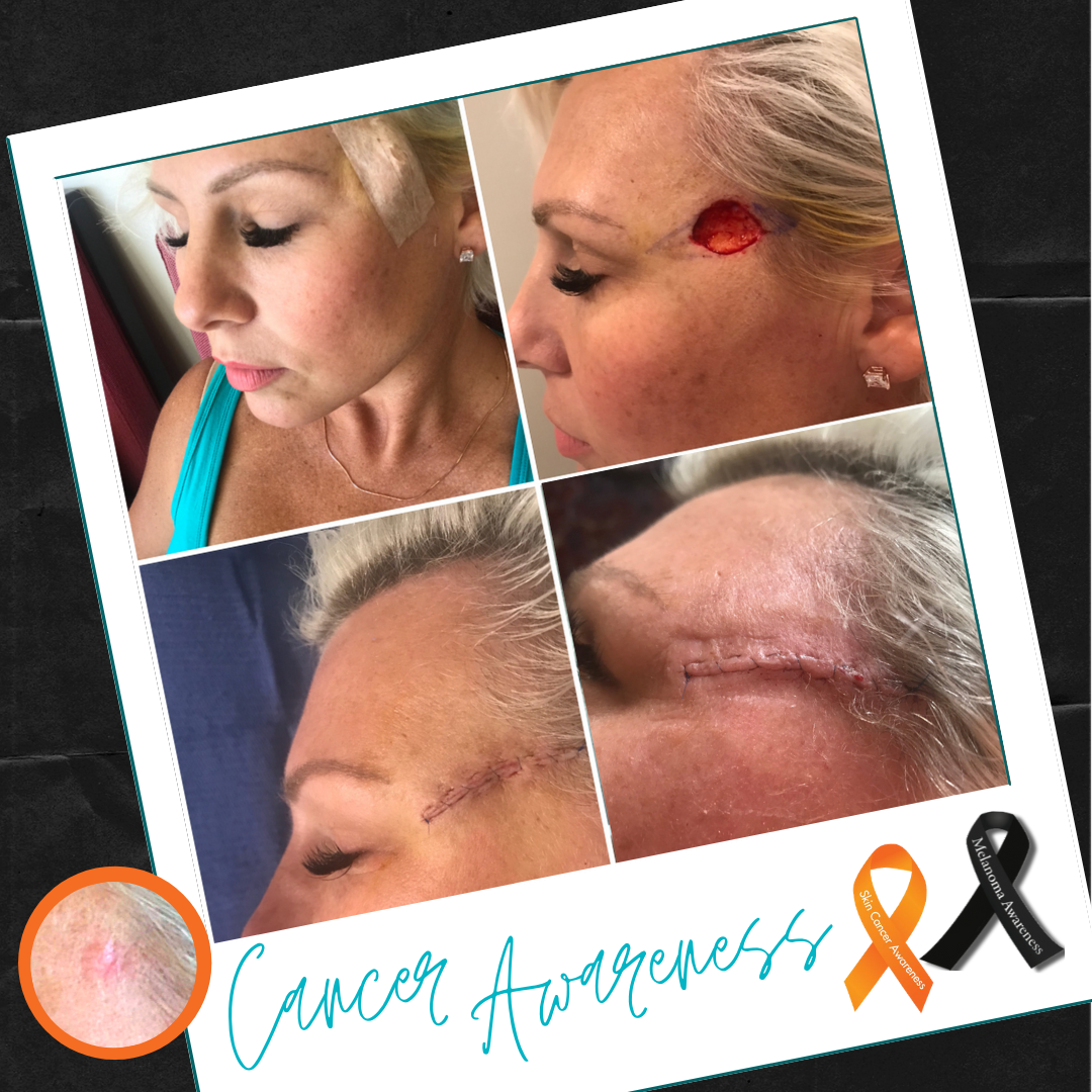 I choose health over vanity!